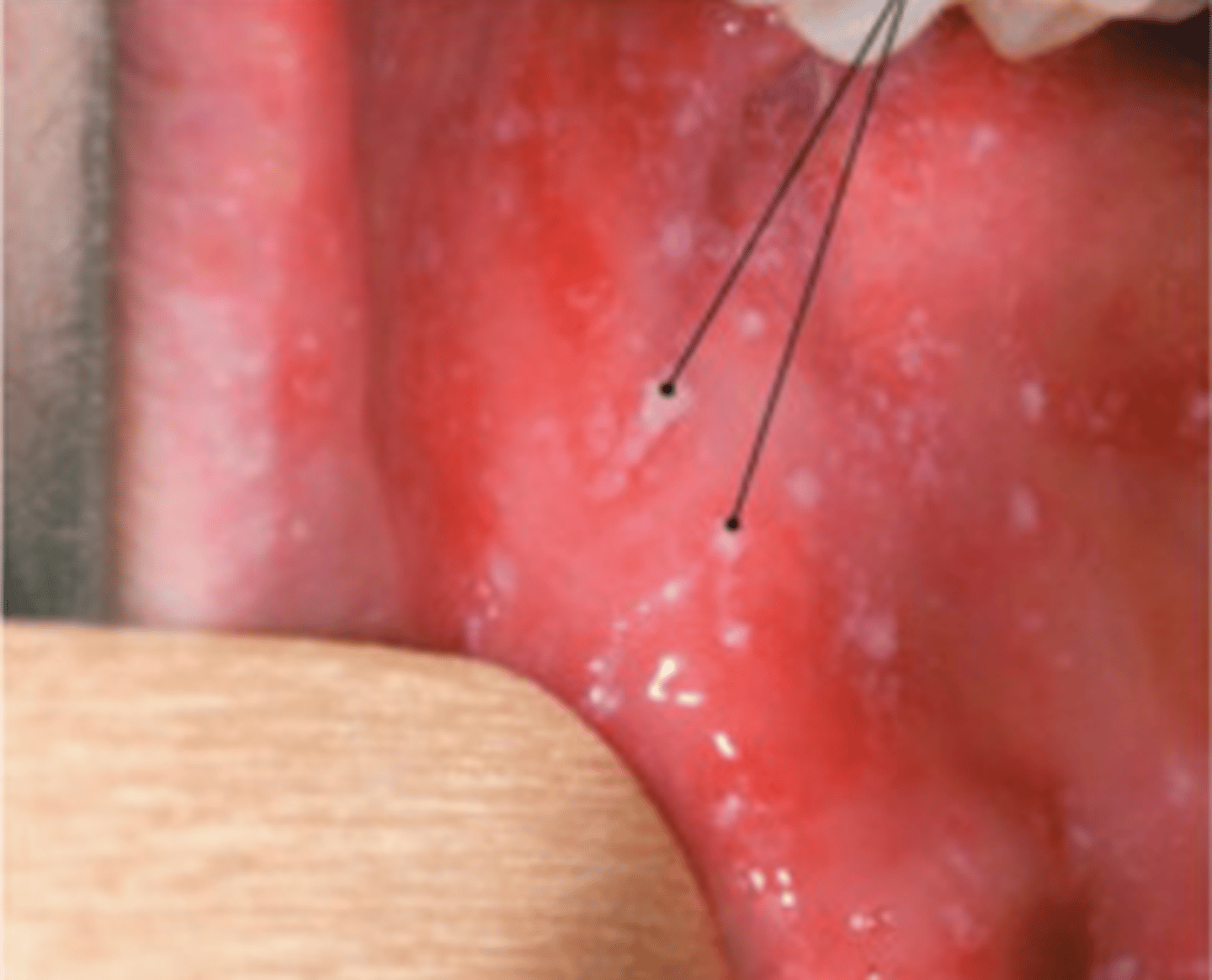 <p>-koplik spots (white spots in mouth)</p>