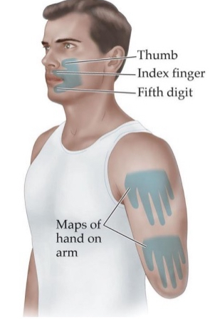 <ul><li><p>Perceived sensation from a physically amputated limb of the body</p></li><li><p>Phantom pain</p><ul><li><p>If someone looses a hand, and you touch their shoulder, they’ll feel like their hand is still being touched. That suggests that those paths in S1 that used to respond to hand now respond to shoulder. But they still have the memory of being responsive to the hand</p></li></ul></li><li><p>Parts of brain “listening” to missing limbs not fully “aware” of altered connections, so they attribute activity in these areas to stimulation from missing limb</p></li><li><p>Mirror “re-instates” complete body</p></li><li><p>Sometimes turn into phantom pain. If you have a cramp in foot you can stretch and get rid of it. But a person who’s foot is gone can’t do that</p><ul><li><p>Mirror therapy for phantom pain</p></li></ul></li></ul><p></p>