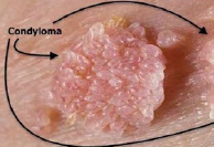 <ul><li><p>Condyloma acuminatum</p></li><li><p>Molluscum contagiosum</p></li></ul>