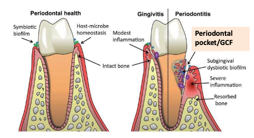 <p><span>Gingival crevicular fluid (GCF) from patients with periodontitis</span></p>