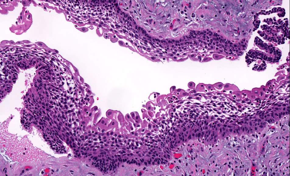 <p>1) Améloblastome unikystique</p><p>2) Tumeur avec invasion locale, souvent associé à une dent incluse </p><p>3) </p><ul><li><p>Cellules basales avec palissading</p></li><li><p>Polarité nucléaire inversée</p></li><li><p>Cellules étoilées superficielles </p></li></ul><p></p>