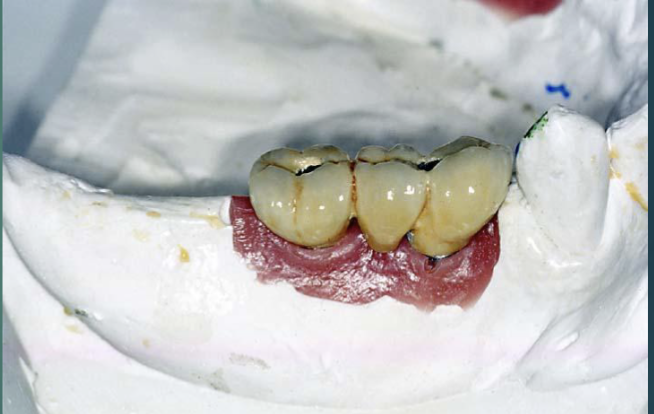 <p>what is soft tissue moulage </p>