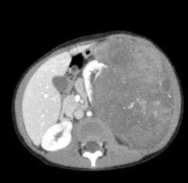 -*US* then CT or MRI
-*evaluate for lung metastasis*
-SCr, CMP, UA, maybe coagulation studies if indicated