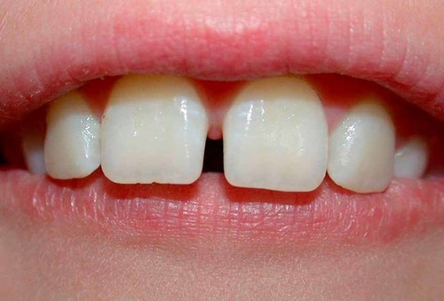 <p>space between teeth (may be caused by maxillary labial frenum)</p>