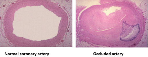 <p>narrows or completely blocks blood vessel, reducing or stopping blood flow</p>