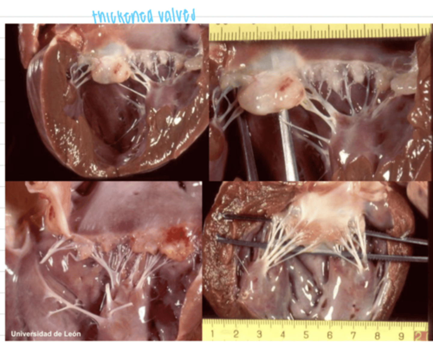 <p>cardiac lesions:</p><p>valve stenosis or insufficiency</p>