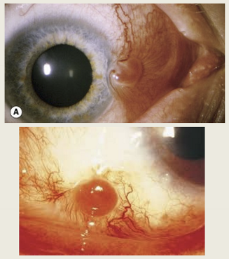 <ul><li><p>Dark pink fleshy conjunctival mass</p></li><li><p>mass tends to be rapidly trowing</p></li><li><p>has more BV than pterygium </p></li></ul><p></p>