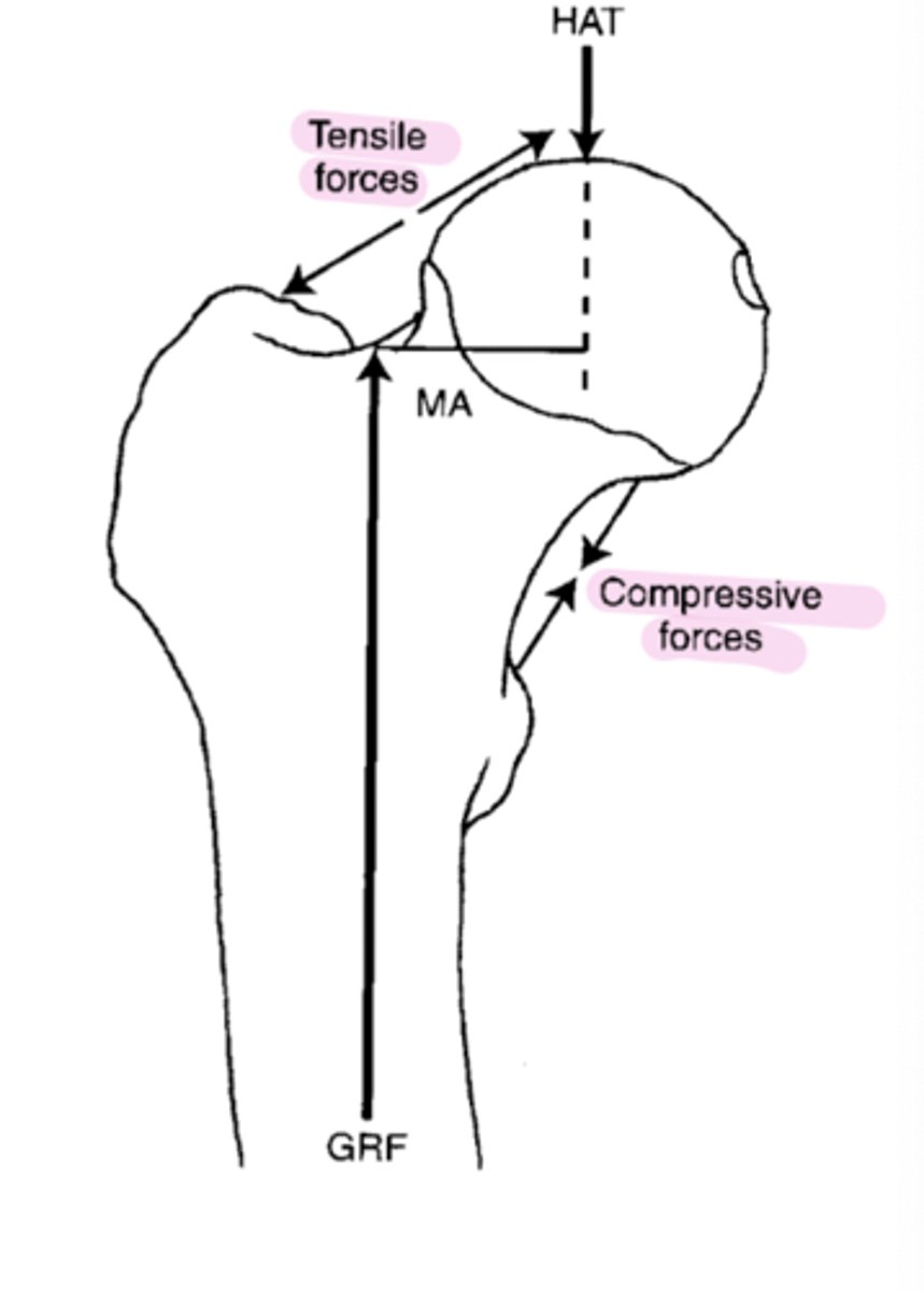 <p>tensile forces on superior femoral neck and compressive forces on inferior femoral neck</p>