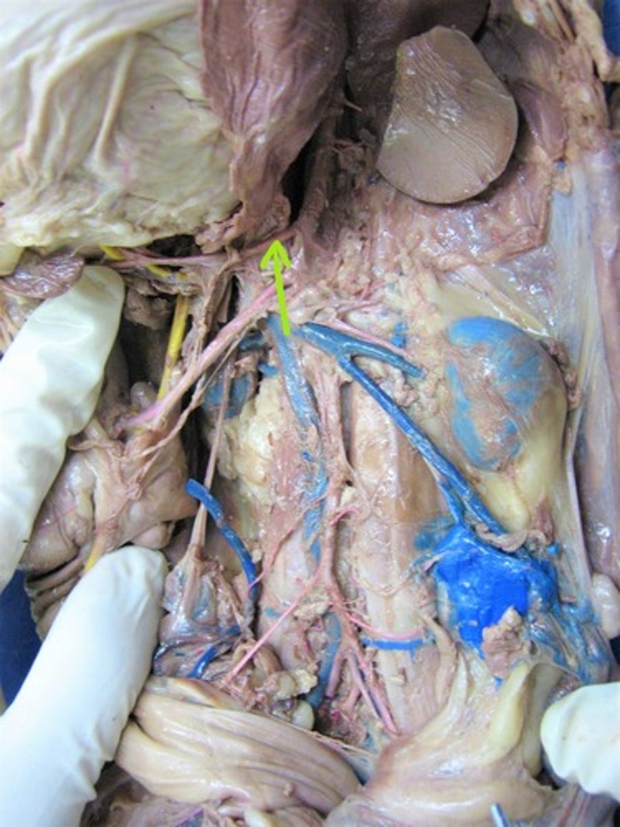 <p>identify this artery</p>
