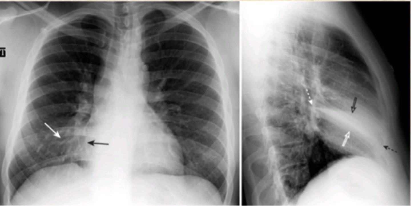 <p>What does this CXR show?</p>