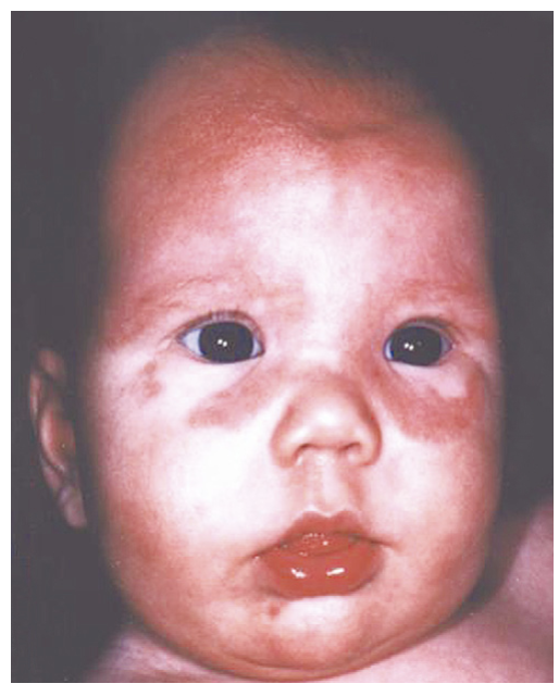 <p>A rare condition that affects the infants of women with lupus leading to skin rashes, liver problems, and heart issues (<em>AV block, valvular lesions</em>)</p>