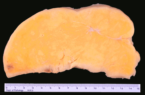 <ol><li><p>Common sites of liposarcoma</p></li><li><p>Gross appearance of liposarcoma</p></li><li><p>Clinical behavior of liposarcoma</p></li></ol><p></p>