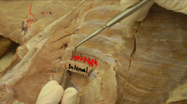 <p><span>Intercostal Muscles (thoracic wall)</span></p>