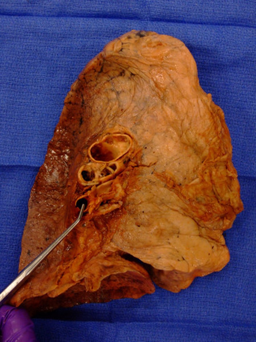 <p>vein</p>