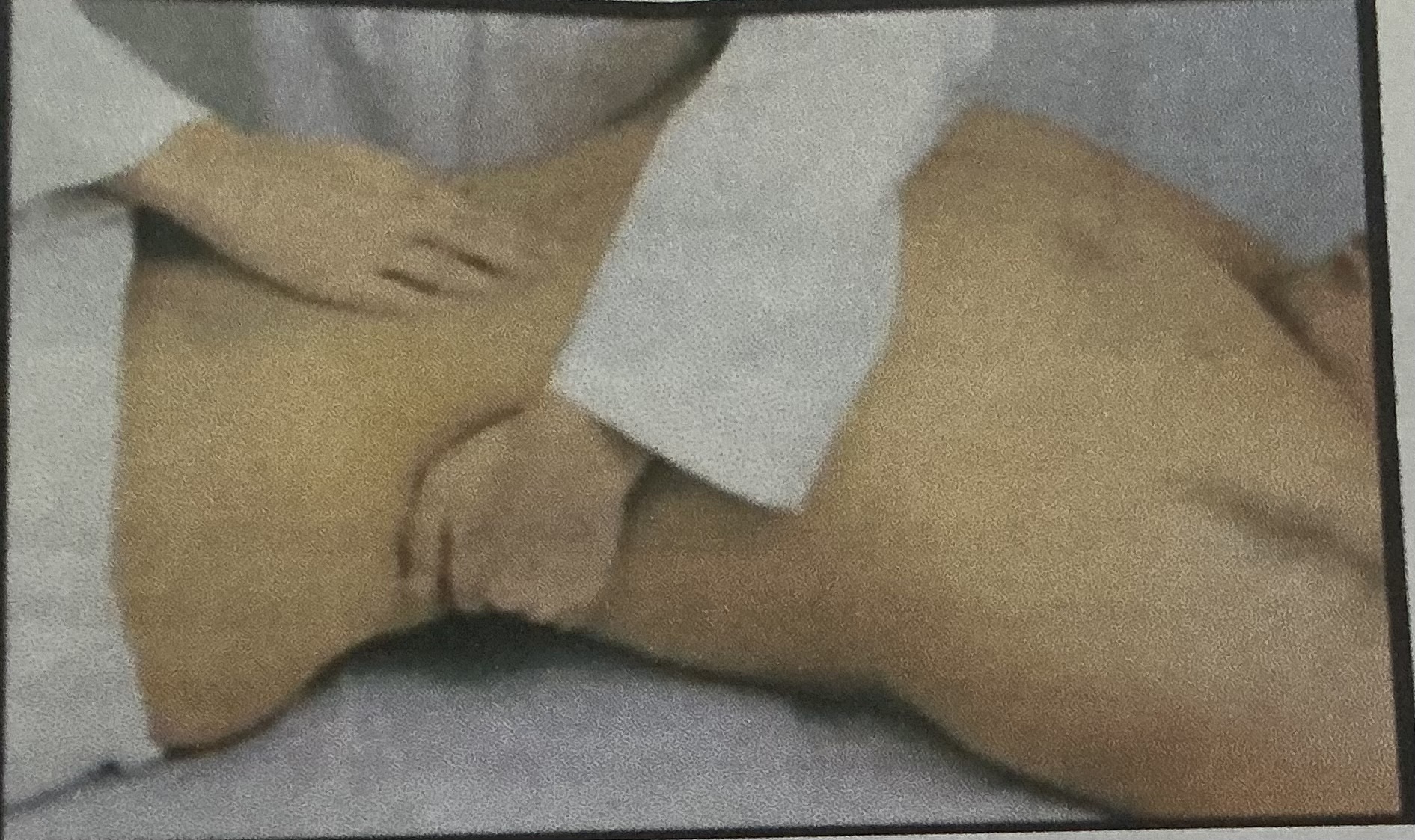 <p>El médico se sitúa en el lado opuesto del riñón que desea examinar. Las manos del explorador se disponen como en el método de Guyon.</p><p>con la <strong>mano posterior de sostén,</strong> se producen bruscos, impulsos en la pared abdominal, flexionando los dedos a nivel de las articulaciones interfalángicas proximales.</p><p>Con la <strong>mano anterior</strong>, deprime la pared abdominal, a fin de advertir el choque contra sus dedos de la visera desplazada hacia adelante. Que sólo se percibe al final de la inspiración.</p>