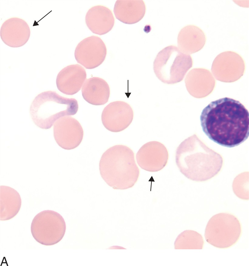 <p>what is a spherocyte?</p>
