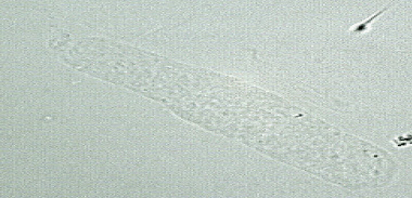 <p>Hyaline Cast</p><p>Most common type. Least significant.</p><p>Tamm-Horsfall protein only.</p><p>Dissolve in alk urine. Same refractive index as urine; may be overlooked with bright light</p>