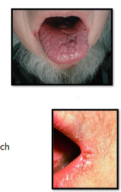 <p><strong><u>IRON DEFICIENCY ANEMIA: PRESENTATION</u></strong></p><ol><li><p>____ nails</p></li><li><p>_________</p></li><li><p>_____ (cracked tongue)</p></li><li><p>_____ (cracked lips)</p></li><li><p>Craving for nonfood items: ______</p></li><li><p>May have _________</p></li><li><p>Lab findings → 3</p></li></ol><p></p>