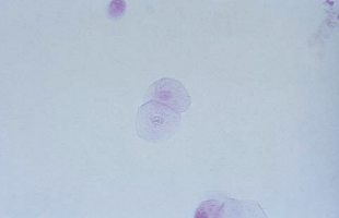 Stained spherical transitional epithelial cells