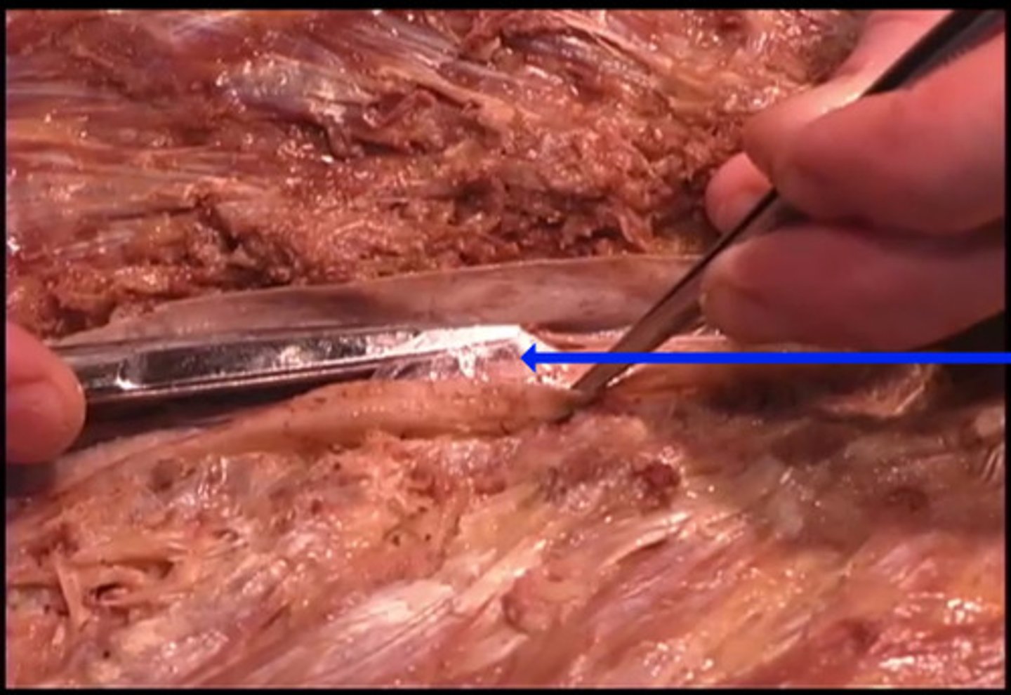 <p>What is the name of the muscle being shown here by the blue arrow?</p><p>dura mater</p><p>pia mater</p><p>arachnoid</p><p>spinal cord</p>