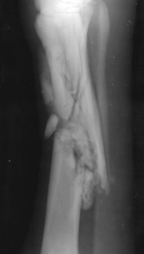 <p>Rounded edges with periosteal new bone (callus), fracture gap may be increased due to healing processes</p>