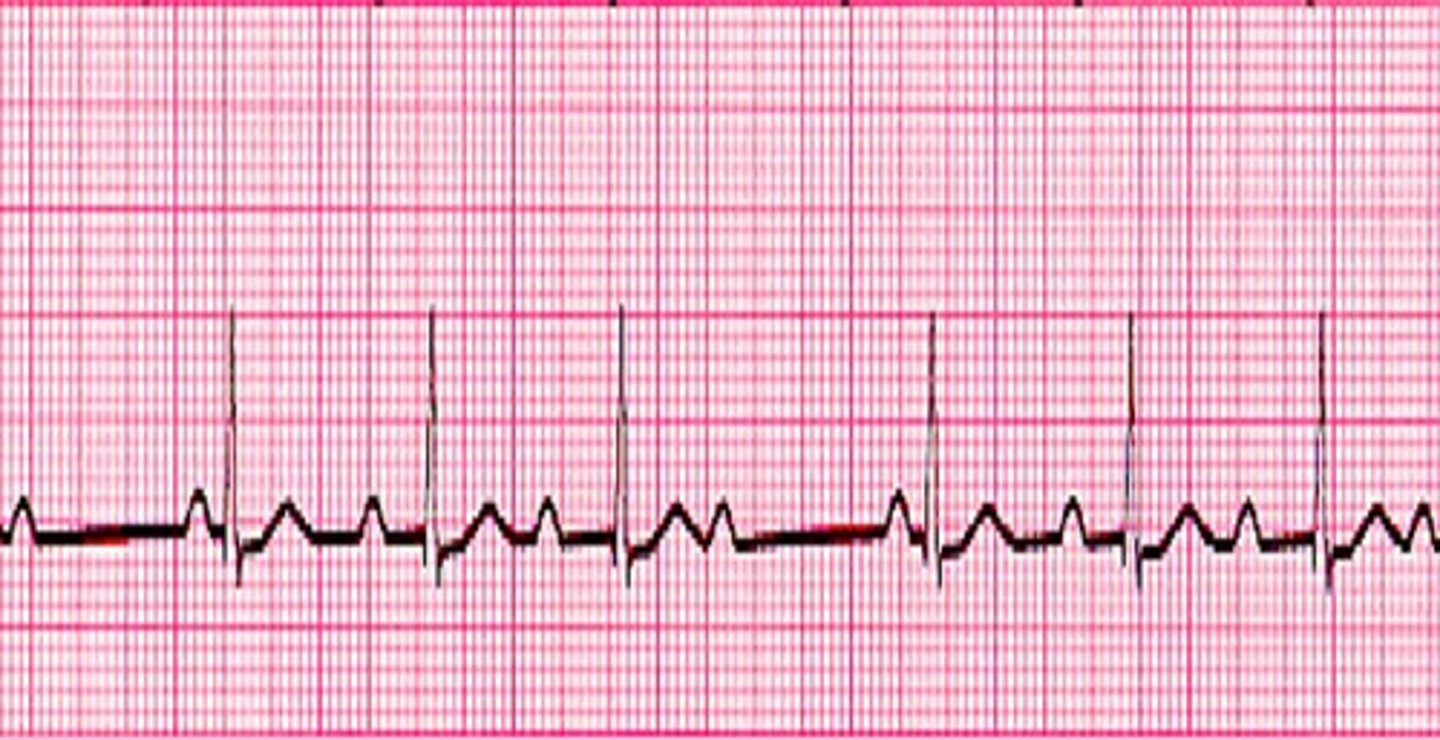 <p>What does the ECG show?</p>