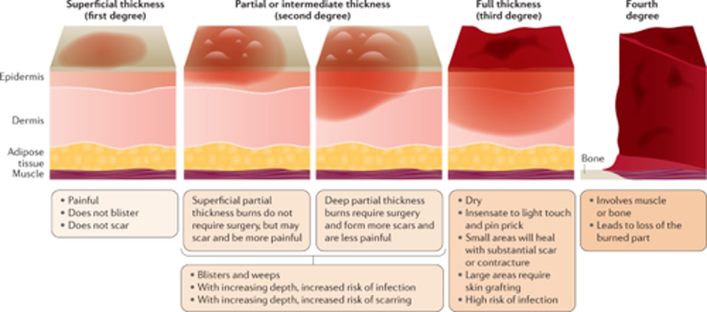<p>Superficial (1st degree): epidermis only; Partial thickness (2nd): dermis involved; Full thickness (3rd): through dermis; 4th: into muscle/bone</p>