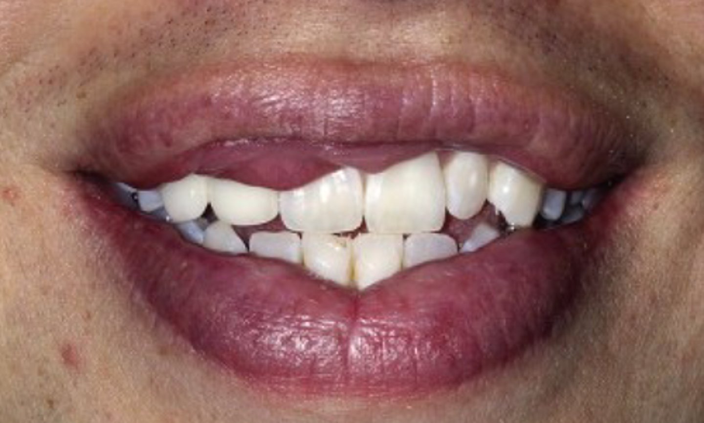 <p>• Redundant fold of tissue on the</p><p>mucosal side of the lip</p><p>• Most cases are congenital, but</p><p>may be acquired</p>
