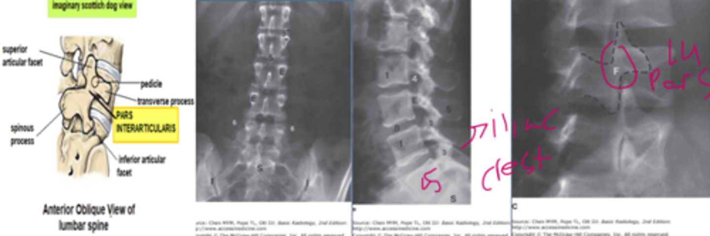 <p>-AP view, lateral view, oblique view</p><p>-Scottie dog sign! (my favorite X-ray finding).</p><p>-The neck of the Scottie dog represents pars interarticularis.</p><p>1=vertebral body</p><p>3=articular facet joint</p><p>4=intervertebral foramen</p><p>5=spinous process</p><p>6=transverse process</p><p>8=intervertebral disk space</p><p>E=pedicle</p><p>F=pars interarticularis</p><p>S=sacrum</p><p>I=sacroiliac joint</p>