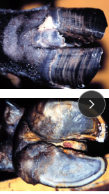 <p><span>Interdigital Fibroma</span></p>