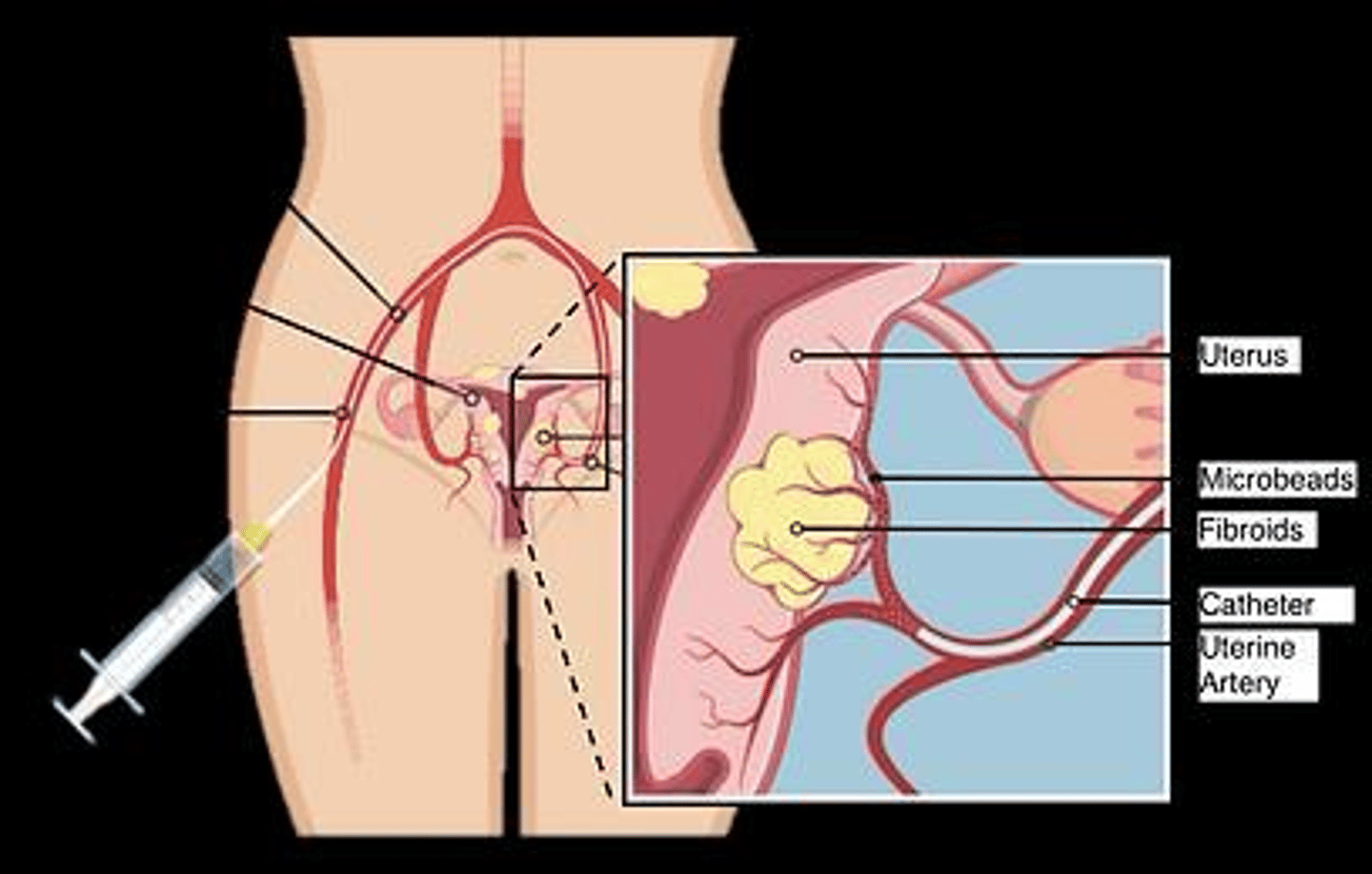 <p>It is a minimally invasive procedure that cuts off blood supply to fibroids; it is generally avoided in patients desiring future pregnancy.</p>