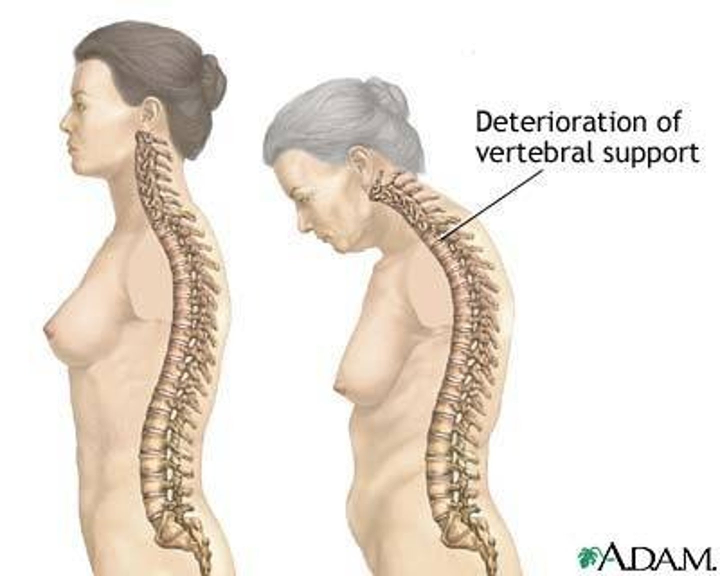 <p>Senile kyphosis </p><p>With increasing age, secondary curvatures begin to disappear</p>