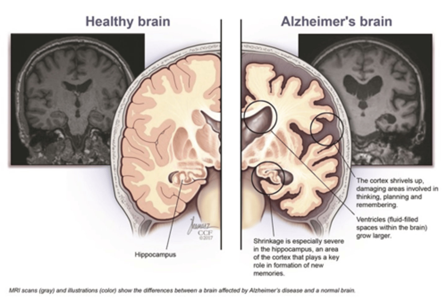 <p>-Diffuse atrophy on CT.</p><p>-Flattened sulci on the cerebral cortex.</p><p>-Enlarged cerebral ventricles.</p><p>-Deficient parietal lobe blood flow.</p><p>-Acetylcholine reduction.</p><p>-Choline acetyltransferase reduction.</p><p>-Reduced metabolism in the temporal and parietal lobes.</p><p>-Beta-amyloid plaques.</p><p>-Neurofibrillary tangles of hyperphosphorylated tau protein.</p>