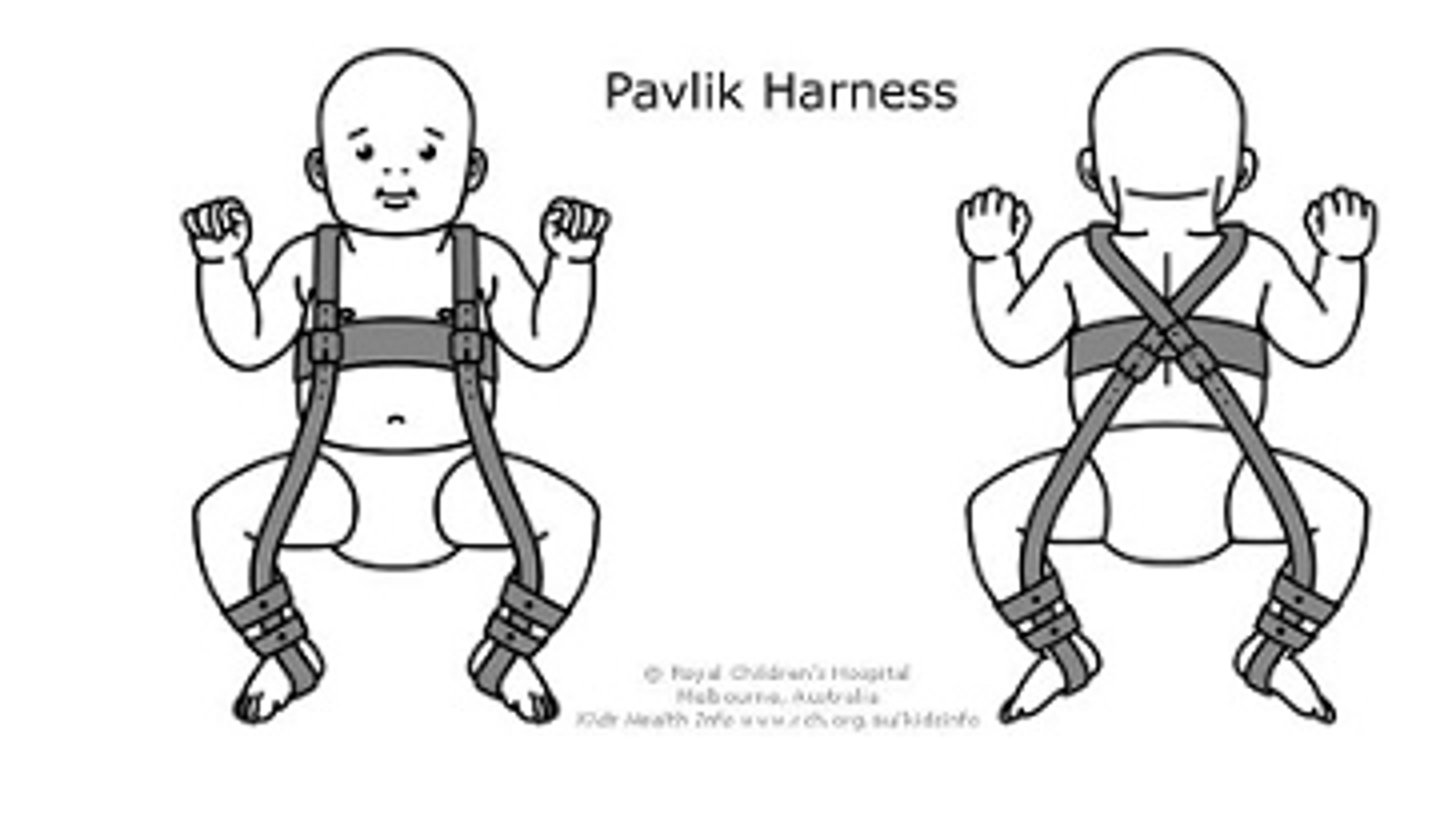 <p>Screening: Ortolani test</p><p>Flex/abduct hips</p><p>Should be equal, produce no click</p><p>Treatment: Pavlik harness</p>