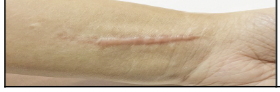 <p>Firm abnormally large scar that grows larger than the original injury due to overproduction of collagen.</p>