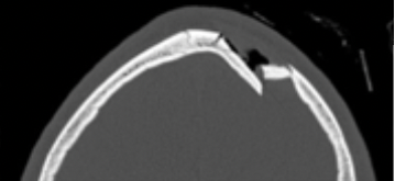 <p>incomplete fracture on one side of depression</p><ul><li><p>outward bending not completely separating</p></li></ul>