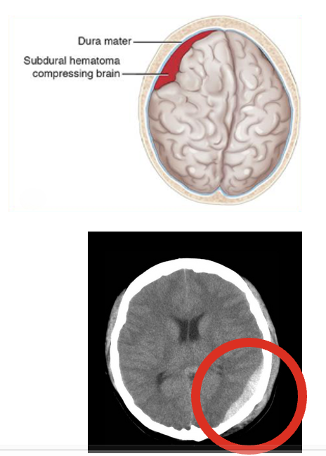<p>Collection of blood between the dura &amp; brain, most commonly d/t trauma; typically from venous sources. (usually from falls)</p><ul><li><p><strong><u>Clinical Manifestations</u></strong>:</p><ul><li><p>Changes in LOC</p></li><li><p>Pupillary signs</p></li><li><p>Hemiparesis (unilateral weakness)</p></li><li><p>Coma, increased BP, decreased HR &amp; RR (<em>cushing’s triad</em>) = rapidly expanding mass → immediate intervention</p></li></ul></li><li><p><strong><u>Management</u></strong>:</p><ul><li><p>Immediate craniotomy — to allow subdural clot to be removed.</p></li><li><p>Outcome is dependent on control of ICP &amp; close monitoring of respiratory function</p></li><li><p>High mortality rate d/t brain damage</p></li></ul></li></ul><p></p>