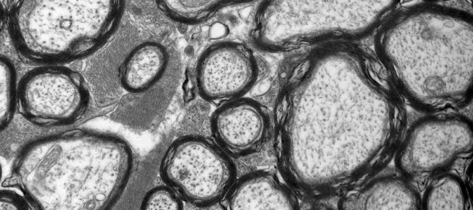 <p>microscope w/ image formed by beams of electrons passing through a thin sample</p>