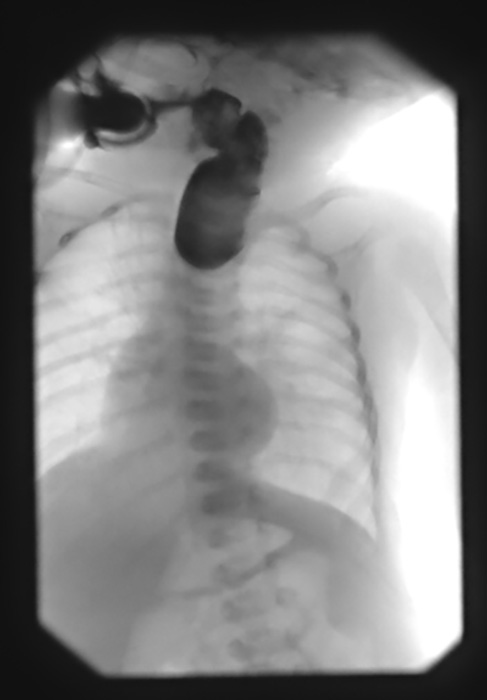 <p>What is the best imaging modality to identify the fistula in acquired TEF?</p>