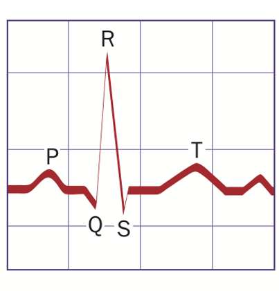 <p>Ventricular depolarization (ventricular contraction).</p>