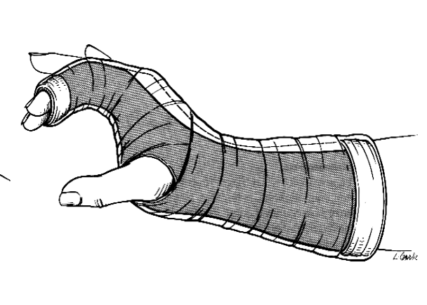 <p><strong>What are indications for radial gutter splinting?</strong></p>