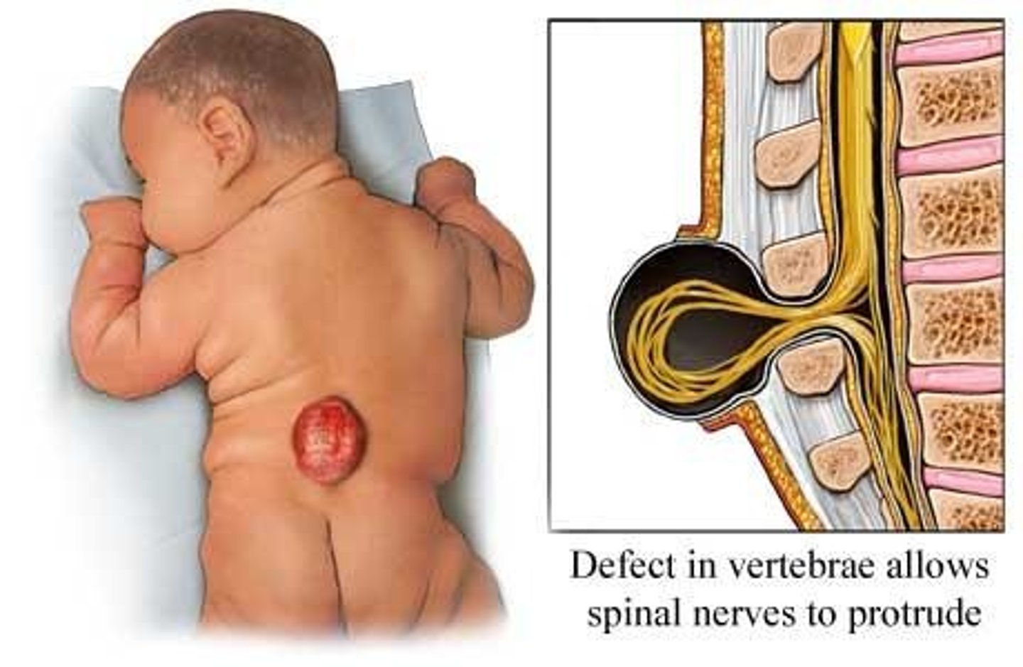 <p>Neural tube defects such as spina bifida.</p>