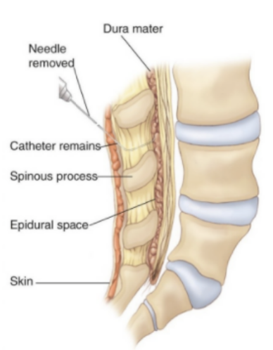 <p>injection of local anesthetic and analgesic into epidural space</p><ul><li><p>continuous block (catheter left in place)</p></li></ul>