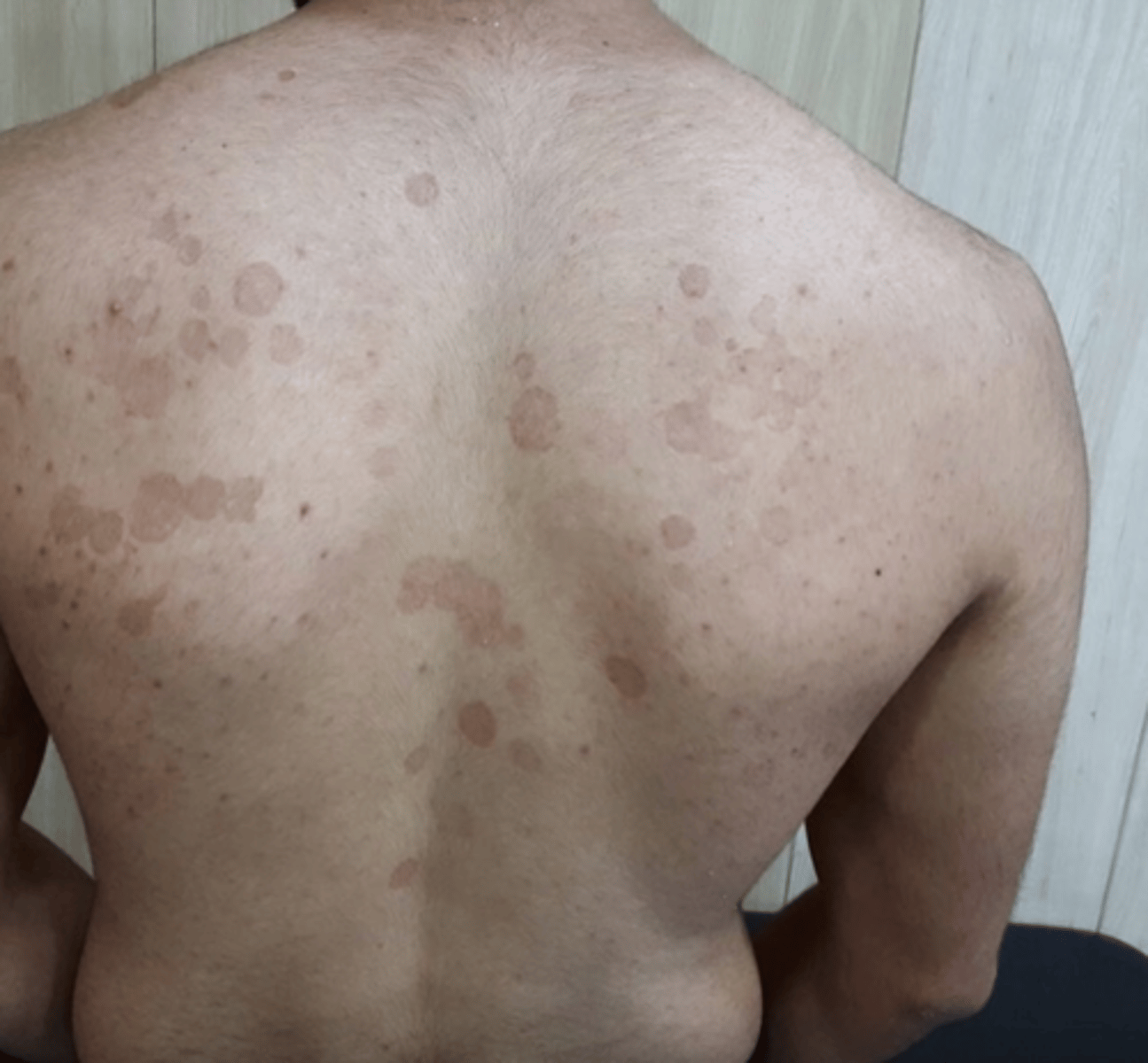 <p>- commonly on chest and bacj</p><p>- patches may be hypopigmented or hyperpigmented (hence versicolor).</p><p>- May be more noticeable following a suntan</p><p>- scale is common</p>