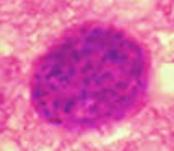 <p><strong>1. Identify the parasite (Genus, species, and stage).</strong><br>→ <em>Toxoplasma gondii</em> true cyst</p><div data-type="horizontalRule"><hr></div><p><strong>2. Mention two morphological characters of this stage.</strong><br>→ - Resting form that contains slowly multiplying bradyzoites<br>→ - Has a true cyst wall</p><div data-type="horizontalRule"><hr></div><p><strong>3. Mention the active form of this parasite.</strong><br>→ <em>Toxoplasma</em> pseudocyst</p><div data-type="horizontalRule"><hr></div><p><strong>4. Identify the types of antibodies detected in serological diagnosis of this disease and their significance.</strong><br>→ - Rising IgG titer and presence of IgM signify active infection<br>→ - IgM detected in a baby’s blood is fetal in origin (maternal IgM does not cross the placenta)<br>→ - IgG antibodies signify chronic (latent) infection</p><div data-type="horizontalRule"><hr></div><p><strong>5. Mention two immunological tests to augment diagnosis.</strong><br>→ - ELISA for detection of anti-<em>Toxoplasma</em> antibodies<br>→ - Immunochromatographic Test (ICT) / Toxo Rapid Test</p>