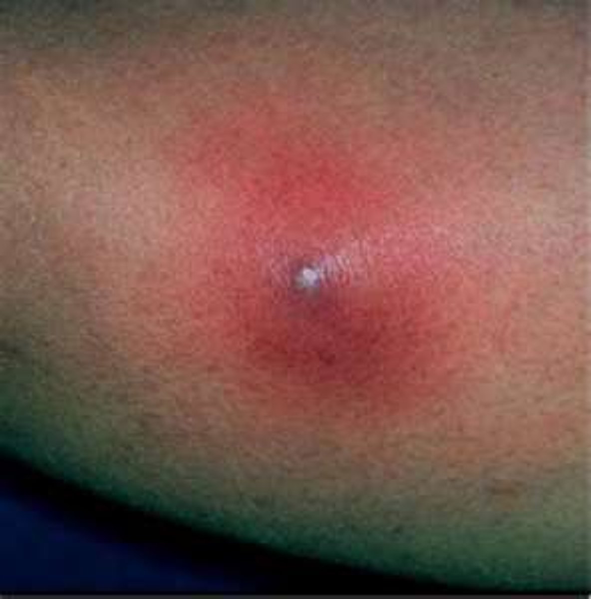 <p>diagnose this image</p><p>infection of hair follicles where purulent material extends through the dermis into SubQ tissue forming an abscess</p>