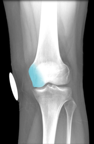 Description:
Medial enlargement of distal end
Smooth surface articulates with tibia
and patella
Comment:
Provides attachment for medial head of
gastrocnemius and adductor magnus
muscles, and tibial collateral ligament of
knee
Latin: condyle = knuckle