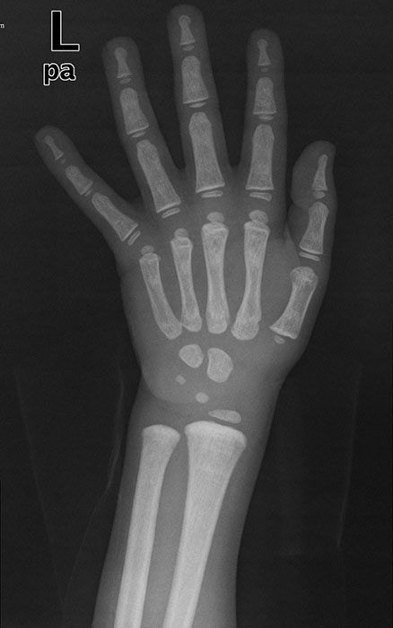 <p>This patient is 6 years old. What pathology do they have?</p>