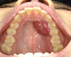 <p>Red, raised nodule on gums (may enlarge)</p>