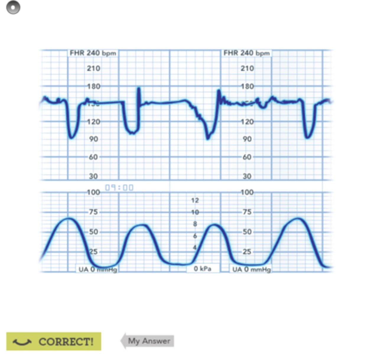 <p>-FHR "varies" in duration, intensity, and timing</p><p>-abrupt deceleration in HR, typically causing "U", "V" or "W" shape</p><p>entire variable occurs in 30 sec</p>